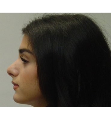 Nose surgery
